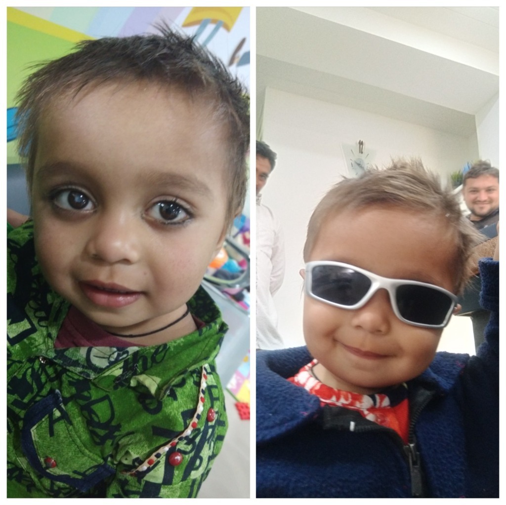 Pediatric cataract