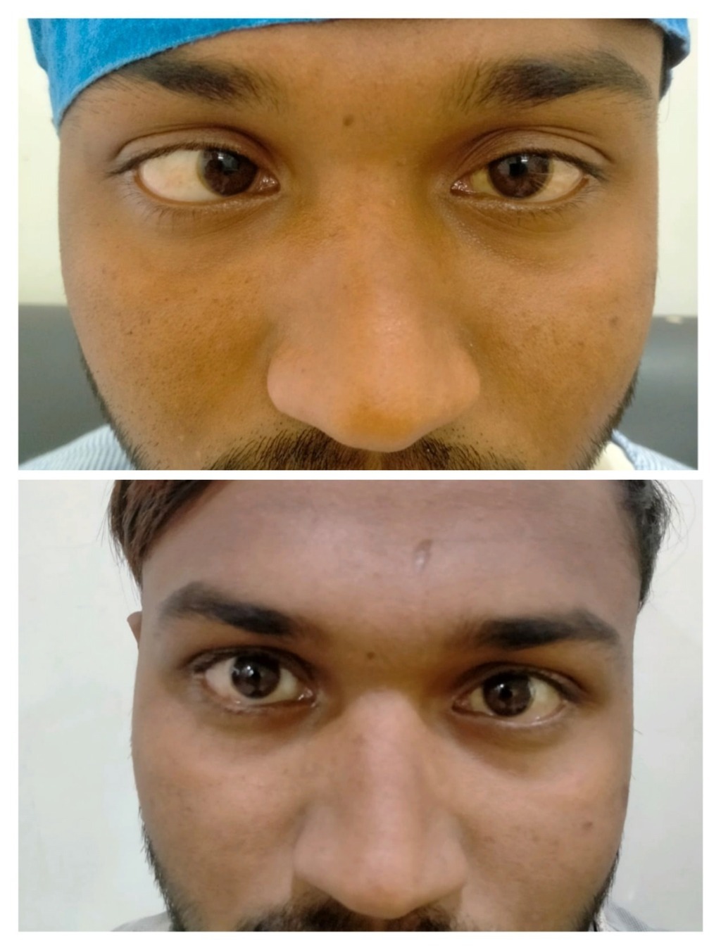 Esotropia