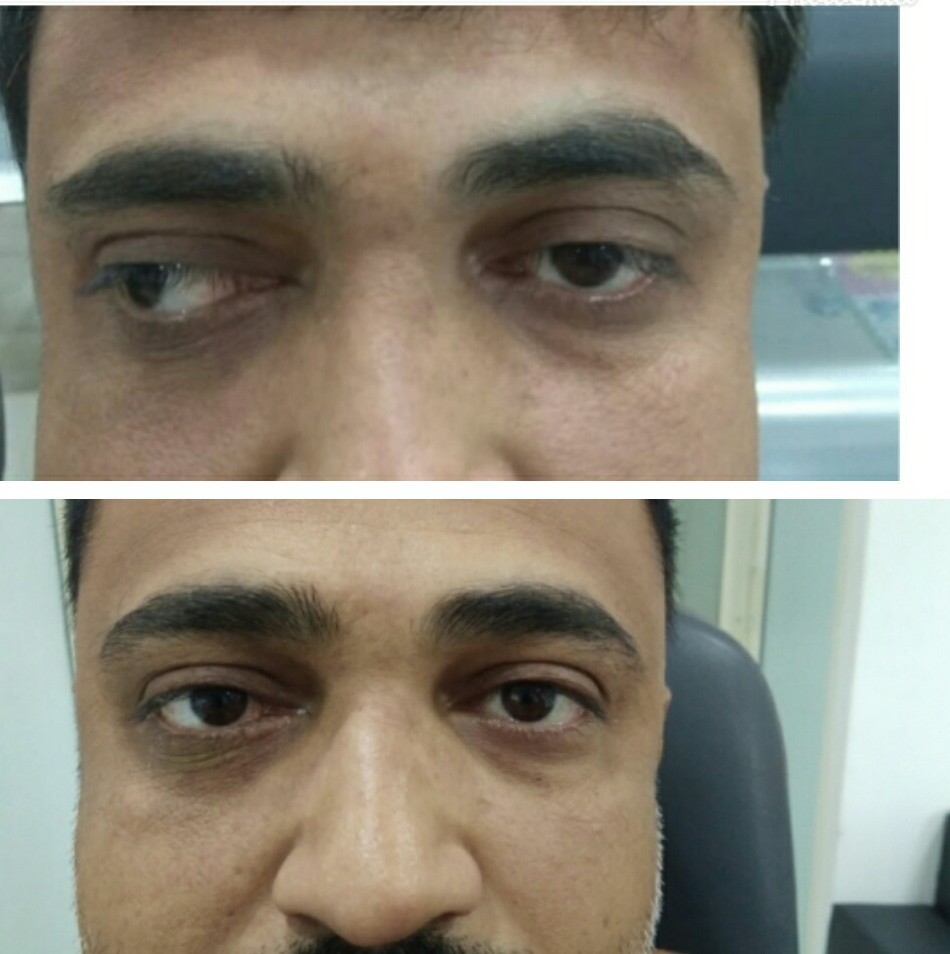 Exotropia