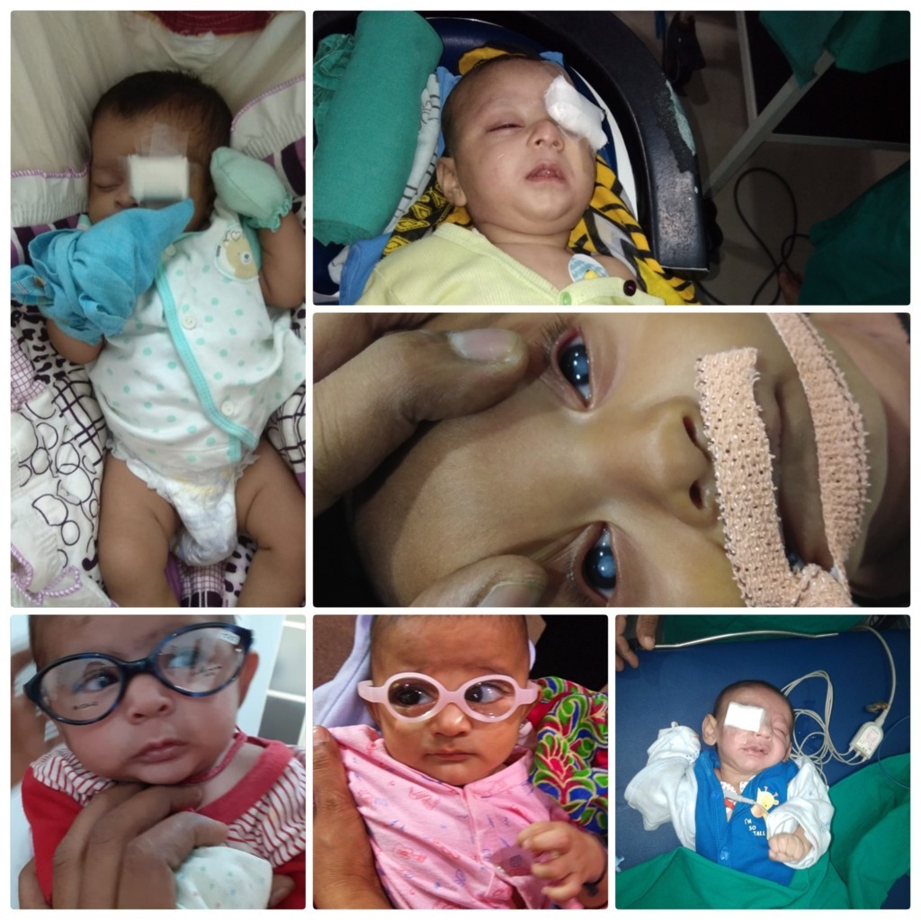 Pediatric cataract